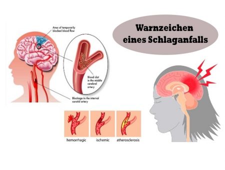 Muss gelesen werden: Warnzeichen eines Schlaganfalls - Durchs Leben